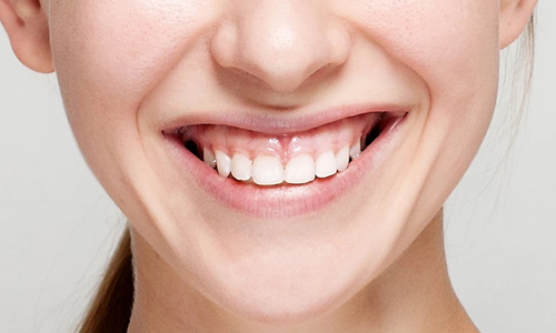 GUMMY SMILE TEDAVİSİ